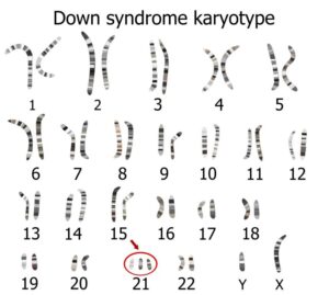 bilder von chromosomen zur Trisomie 21
