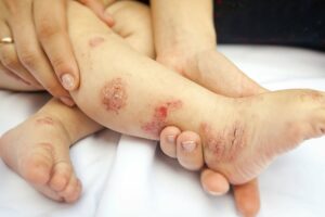 Hand Fuß Mund Krankheit Hausmittel