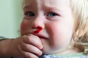 Nasenbluten bei einem Kleinkind